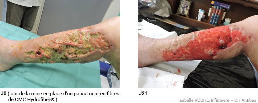 Plaie traumatique dans un contexte d’insuffisance veineuse chronique : détersion prise en charge avec AQUACEL® Extra™-7 J0 (jour de la mise en place d’ AQUACEL® Extra™)-10 et J21 (Visuel Isabelle ROCHE, Infirmière – CH Antibes) 