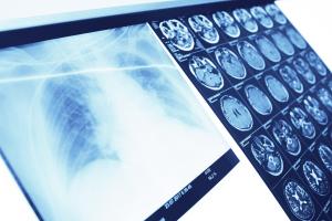 Cette étude se concentre sur les effets des particules fines PM2,5 et des hydrocarbures aromatiques polycycliques (HAP) sur la motricité après un accident vasculaire cérébral (AVC) (Visuel Adobe Stock 175074485) Cette étude se concentre sur les effets des particules fines PM2,5 et des hydrocarbures aromatiques polycycliques (HAP) sur la motricité après un accident vasculaire cérébral (AVC) (Visuel Adobe Stock 175074485)