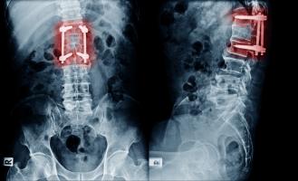 Des implants intelligents, auto-alimentés permettent de surveiller la guérison de lésions et troubles de la colonne vertébrale (Visuel Adobe stock 214542321) Des implants intelligents, auto-alimentés permettent de surveiller la guérison de lésions et troubles de la colonne vertébrale (Visuel Adobe stock 214542321)