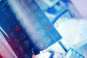 Une réaction chimique dans le cerveau, appelée neddylation, pourrait stabiliser le canal sodium (Adobe Stock 228893665) Une réaction chimique dans le cerveau, appelée neddylation, pourrait stabiliser le canal sodium (Adobe Stock 228893665)