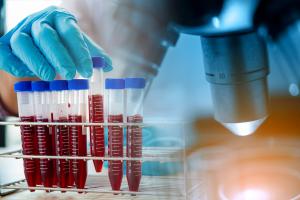 C’est une nouvelle technique qui permet d’identifier des particules pathogènes dans le sang qui annoncent le développement d’une maladie auto-immune, le lupus (Visuel Adobe Stock 283646387) C’est une nouvelle technique qui permet d’identifier des particules pathogènes dans le sang qui annoncent le développement d’une maladie auto-immune, le lupus (Visuel Adobe Stock 283646387)