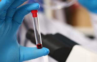 Des résultats d'essais cliniques très encourageants sur un nouveau traitement contre un cancer rare de la moelle osseuse, la myélofibrose (Visuel Adobe Stock 305239900) Des résultats d'essais cliniques très encourageants sur un nouveau traitement contre un cancer rare de la moelle osseuse, la myélofibrose (Visuel Adobe Stock 305239900)