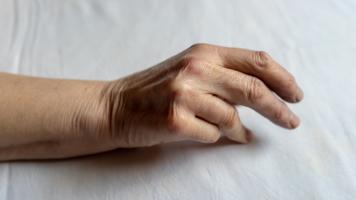 Cet essai démontre l’efficacité d’un biomédicament anti-TNF, l'adalimumab, chez les patients atteints de la maladie de Dupuytren à stade précoce (Visuel Adobe Stock 342816557) Cet essai démontre l’efficacité d’un biomédicament anti-TNF, l'adalimumab, chez les patients atteints de la maladie de Dupuytren à stade précoce (Visuel Adobe Stock 342816557)