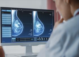 Le dépistage mammographique assisté par l’IA permet de réduire le nombre des cancers du sein agressifs et avancés (Visuel Adobe Stock 422714239)