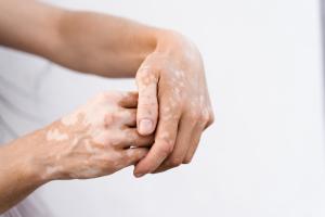 Dans le vitiligo, la suppression d'une enzyme en particulier, pourrait permettre aux mélanocytes de récupérer (Visuel Adobe Stock 512322056) Dans le vitiligo, la suppression d'une enzyme en particulier, pourrait permettre aux mélanocytes de récupérer (Visuel Adobe Stock 512322056)