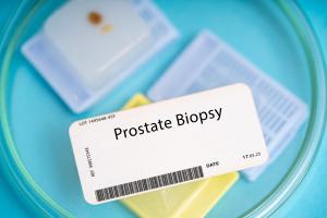 Une nouvelle technique de collecte d'échantillons de biopsie de la prostate, qui permet de réduire le risque d'infection par rapport aux approches traditionnelles (Visuel Adobe Stock 595758560)