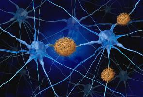 Le médicament restaure la fonction neuronale en empêchant les neurones de produire la protéine bêta-amyloïde toxique (Visuel Adobe Stock 717543805) Le médicament restaure la fonction neuronale en empêchant les neurones de produire la protéine bêta-amyloïde toxique (Visuel Adobe Stock 717543805)