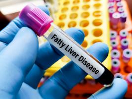 C’est un fait, chez les patients trisomiques, le vieillissement exacerbe le stress oxydatif ce qui finit par mener à la fibrose hépatique (Visuel Adobe Stock 764582361)