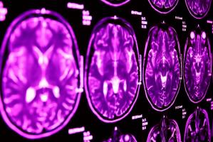 Une altération génétique explique une grande partie des symptômes communs entre l'autisme et le syndrome de la Tourette Une altération génétique explique une grande partie des symptômes communs entre l'autisme et le syndrome de la Tourette