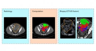 Cette technique d’échantillonnage de précision à base d’imagerie de base évite aux patients trop de procédures invasives et marque une étape importante dans une prise en charge mieux personnalisée et moins stressante des patients (Visuel Evis Sala/University of Cambridge) Cette technique d’échantillonnage de précision à base d’imagerie de base évite aux patients trop de procédures invasives et marque une étape importante dans une prise en charge mieux personnalisée et moins stressante des patients (Visuel Evis Sala/University of Cambridge)