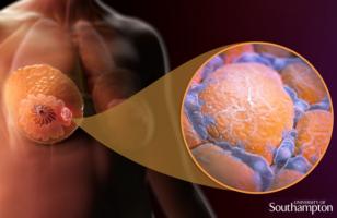 Un marqueur spécifique présent chez les patientes en surpoids et obèses, pourrait entraver leur réponse au traitement (Visuel University of Southampton). Un marqueur spécifique présent chez les patientes en surpoids et obèses, pourrait entraver leur réponse au traitement (Visuel University of Southampton).