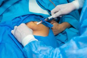 La forte perte de poids liée à la chirurgie entraînerait une plus grande fragilité du « squelette », un risque accru de chutes et donc de fractures osseuses.