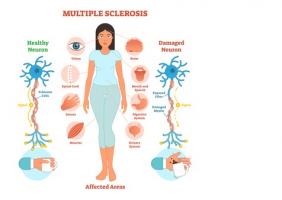Ces signes recensés, perceptibles des années avant l'apparition des premiers symptômes reconnus de la SEP correspondent à un risque multiplié par 4 de développer des troubles du système nerveux. Ces signes recensés sont perceptibles des années avant l'apparition des premiers symptômes reconnus de la SEP correspondent à un risque multiplié par 4 de développer des troubles du système nerveux