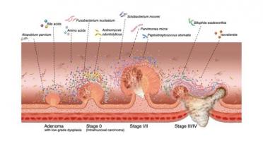 L’intestin « le sent bien » : certains changements du microbiome intestinal peuvent être des signes précoces du cancer colorectal L’intestin « le sent bien » : certains changements du microbiome intestinal peuvent être des signes précoces du cancer colorectal