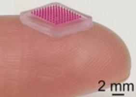 Ce patch « microneedle » ou microaiguilles va permettre de délivrer des antibiotiques localement par voie cutanée et de limiter ainsi les traitements systémiques (Visuel Institut Karolinska ) . Ce patch « microneedle » ou microaiguilles va permettre de délivrer des antibiotiques localement par voie cutanée et de limiter ainsi les traitements systémiques (Visuel Institut Karolinska ) .