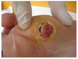 Les plaies chroniques touchent plus d’un million de Français, l’Assurance maladie fait état de dépenses de prise en charge de près d’un milliard d’euros pour le soin des escarres et des ulcères -dont ulcère du pied diabétique Les plaies chroniques touchent plus d’un million de Français, l’Assurance maladie fait état de dépenses de prise en charge de près d’un milliard d’euros pour le soin des escarres et des ulcères -dont ulcère du pied diabétique