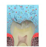 Un nouveau composite, ou un nouveau dentifrice préventif illustreront bientôt cette alternative aux soins actuels : la reminéralisation guidée par les peptides.
