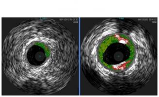 Ce n'est que récemment que l'allergène principal de la viande rouge, appelé galactose-α-1,3-galactose, ou alpha-Gal, un type de sucre complexe a été identifié. Ce n'est que récemment que l'allergène principal de la viande rouge, appelé galactose-α-1,3-galactose, ou alpha-Gal, un type de sucre complexe a été identifié.