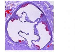 La maladie est caractérisée par un rétrécissement des parois artérielles résultant de l'accumulation (athérome) de lipides et de cellules, appelée plaque d’athérome. La maladie est caractérisée par un rétrécissement des parois artérielles résultant de l'accumulation (athérome) de lipides et de cellules, appelée plaque d’athérome.