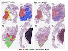 C’est une première démonstration de la performance élevée de l'apprentissage automatique dans le cadre d'une tâche de classification d'images complexes et des applications possibles dans le diagnostic des cancers, mais pas seulement. C’est une première démonstration de la performance élevée de l'apprentissage automatique dans le cadre d'une tâche de classification d'images complexes et des applications possibles dans le diagnostic des cancers, mais pas seulement.