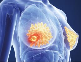 Le tissu adipeux inhibe une enzyme clé ce qui déclenche l'expression de gènes "pro-métastases" Le tissu adipeux inhibe une enzyme clé ce qui déclenche l'expression de gènes "pro-métastases"