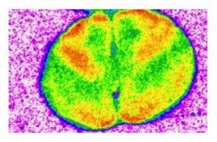 Les souris exposées à long terme au médicament présentent des troubles de la mémoire au point de ne plus pouvoir faire la distinction entre un objet familier et un nouvel objet Les souris exposées à long terme au médicament présentent des troubles de la mémoire au point de ne plus pouvoir faire la distinction entre un objet familier et un nouvel objet