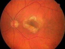 Alors que la formation excessive de vaisseaux sanguins (angiogenèse) dans l'œil est impliquée dans la dégénérescence maculaire liée à l'âge, la rétinopathie diabétique proliférante, le glaucome néovasculaire et la rétinopathie des prématurés, des causes majeures de cécité, les isoflavonoïdes d'origine naturelle -ici extraits de plantes la famille des Hyacinthaceae, confirment ici une capacité antiproliférative puissante dans les cellules endothéliales et un fort potentiel anti-angiogénique in vitro et in vi