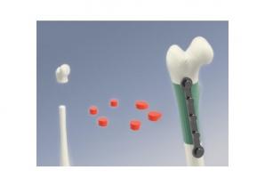 Avec le vieillissement des populations, le fardeau des carences osseuses augmente rapidement. Avec le vieillissement des populations, le fardeau des carences osseuses augmente rapidement.