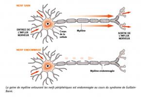 Une association forte entre une infection au COVID-19 et le syndrome de Guillain-Barré. apparaît peu mprobable (Schéma Orphanet) Une association forte entre une infection au COVID-19 et le syndrome de Guillain-Barré. apparaît peu mprobable (Schéma Orphanet)