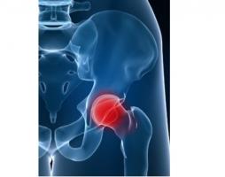 Dans certains cas ces marqueurs urinaires annoncent l’ostéolyse jusqu’à 6 ans avant le diagnostic. Dans certains cas ces marqueurs urinaires annoncent l’ostéolyse jusqu’à 6 ans avant le diagnostic.