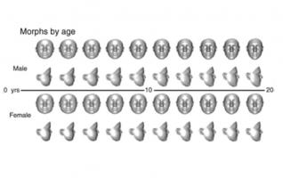 L'analyse faciale en 3D pourrait permettre d’accélérer la détection et le diagnostic des maladies rares chez l’Enfant. (Visuel Genetics in Medicine) L'analyse faciale en 3D pourrait permettre d’accélérer la détection et le diagnostic des maladies rares chez l’Enfant. (Visuel Genetics in Medicine)