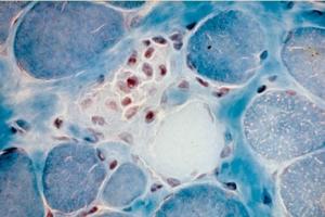 Une protéine, Piezo1, est démontrée ici comme essentielle pour rassembler les formes uniques des cellules souches musculaires mais est présente à des niveaux insuffisants chez les patients atteints de dystrophie musculaire de Duchenne (Visuel Fotolia) Une protéine, Piezo1, est démontrée ici comme essentielle pour rassembler les formes uniques des cellules souches musculaires mais est présente à des niveaux insuffisants chez les patients atteints de dystrophie musculaire de Duchenne (Visuel Fotolia)