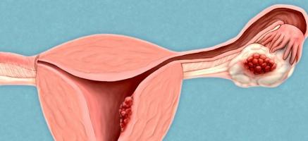 Le cancer de l'ovaire reste l'un des cancers les plus meurtriers car il n'existe aujourd’hui aucune méthode de dépistage et qu'il est souvent diagnostiqué (trop) tardivement. Le cancer de l'ovaire reste l'un des cancers les plus meurtriers car il n'existe aujourd’hui aucune méthode de dépistage et qu'il est souvent diagnostiqué (trop) tardivement.