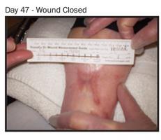 En augmentant l'apport en oxygène mais de manière ciblée sur la plaie, on l’aide à mieux cicatriser