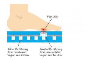 Cette nouvelle semelle pourrait révolutionner le soin de l'ulcère du pied diabétique. Cette nouvelle semelle pourrait révolutionner le soin de l'ulcère du pied diabétique.