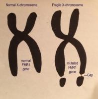 Chez les patients « X fragile », le gène FMR1, présent sur le chromosome X, est complètement désactivé Chez les patients « X fragile », le gène FMR1, présent sur le chromosome X, est complètement désactivé