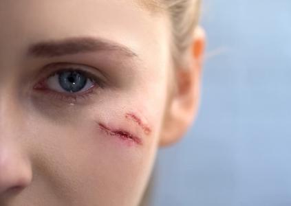 Pourquoi une plaie au visage laisse en général moins "de cicatrice" (ou fibrose)  que sur le reste du corps (Visuel Adobe Stock 239796552)