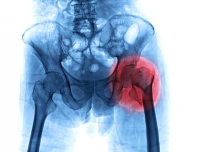 Quelles sont les caractéristiques- patients pouvant contribuer à une mauvaise récupération après une arthroplastie de la hanche ? (Visuel Adobe Stock 287402884)