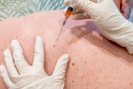 Ces travaux identifient un mécanisme clé dans le développement du cancer de la peau : l'interaction entre une protéine clé et un canal ionique endolysosomal (Visuel Adobe Stock 357671552)