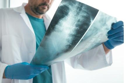 Les patients atteints de fractures vertébrales causées par des tumeurs ou l'ostéoporose subissent généralement une procédure appelée cyphoplastie, qui consiste à combler la fracture par un ciment chirurgical.