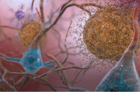 Tau dévore l’ARN et perturbe l'ARN cellulaire (Visuel Université du Colorado à Boulder)