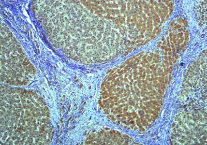 Pour environ 300 millions d’adultes et d’enfants vivant avec une stéatose hépatique non alcoolique dans le monde, le développement d’une cirrhose du foie ou la formation de cicatrices, sont des facteurs importants de survie. 