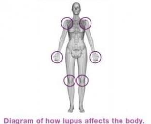 Le lupus touche en majorité des femmes