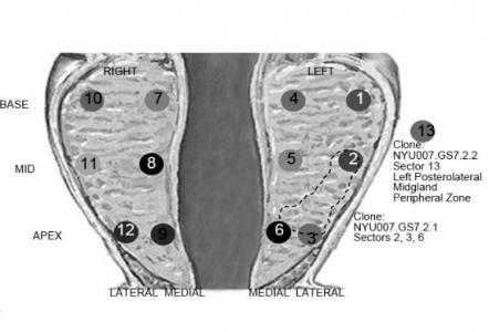 Des outils génomiques avancés pour analyser ce que les médecins appellent des « noyaux de biopsie » et évaluer dans quelle mesure la tumeur s’est déjà propagée.