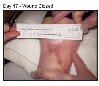 En augmentant l'apport en oxygène mais de manière ciblée sur la plaie, on l’aide à mieux cicatriser