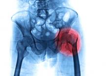 Quelles sont les caractéristiques- patients pouvant contribuer à une mauvaise récupération après une arthroplastie de la hanche ? (Visuel Adobe Stock 287402884)