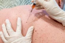 Ces travaux identifient un mécanisme clé dans le développement du cancer de la peau : l'interaction entre une protéine clé et un canal ionique endolysosomal (Visuel Adobe Stock 357671552)