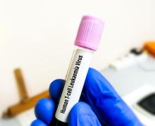 Des médicaments anti-VIH existants peuvent inhiber la transmission du virus HTLV-1 (Visuel Adobe Stock 561027048)