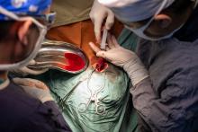 Combiner une chirurgie et l’embolisation pour traiter les hématomes sous-duraux réduit le risque de récidive et de nouvelle chirurgie (Visuel Adobe Stock 752345247)