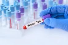 Ce n’est pas la première fois que le virus l'herpès simplex-1 (HSV-1) est mis en cause comme déclencheur de la maladie d’Alzheimer et plus largement de tauopathie (Visuel Adobe Stock 895559425)
